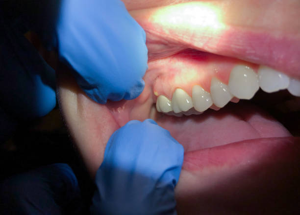 Best Emergency Treatment for Dental Infections or Abscesses in Moundridge, KS