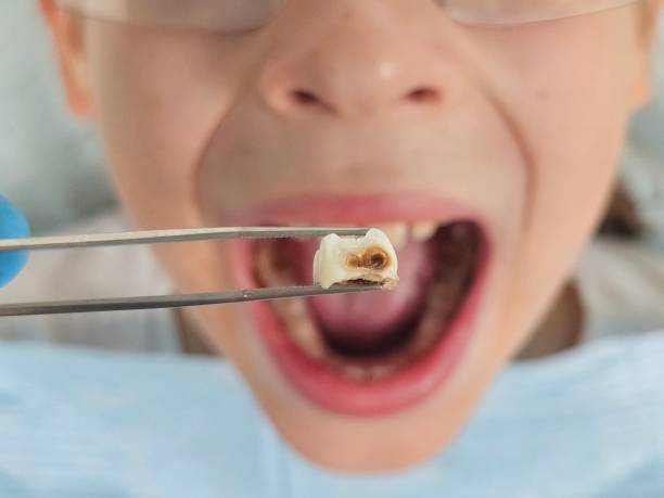Best Emergency Dental Care for Broken or Chipped Teeth in Moundridge, KS